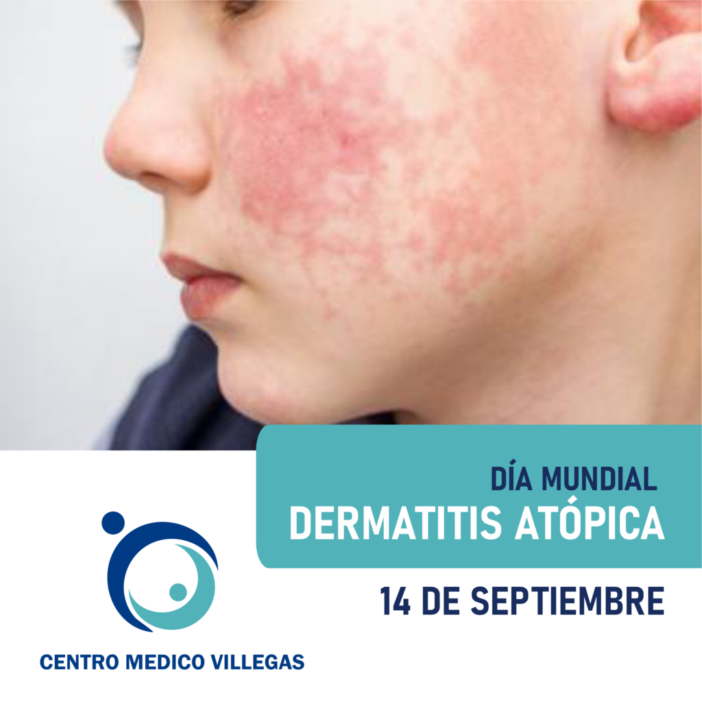 Norit - Hoy es el día mundial de la Dermatitis atópica, un trastorno que  provoca el enrojecimiento de la piel y picazón🔥. Aunque por supuesto lo  que te recomendamos es que vayas